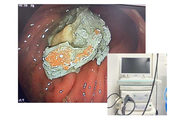 内視鏡を用いた負担の少ない検査・治療